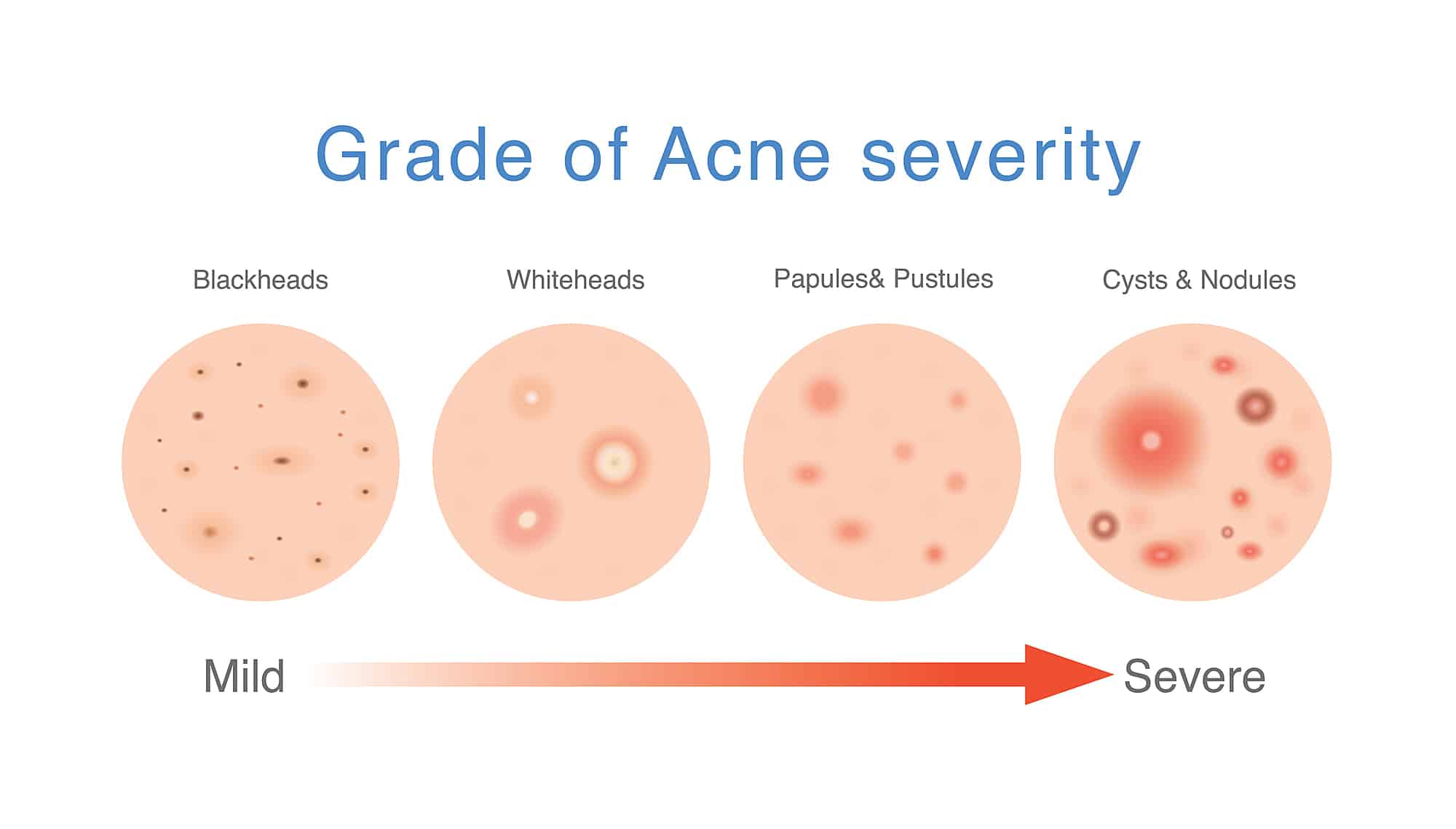 How to Cure Hormonal Cystic Acne Naturally: Step-By-Step Plan